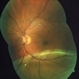 Inferior Rhegmatogenous Retinal Detachment with Subretinal Fibrosis Inferior Rhegmatogenous Retinal Detachment with Subretinal Fibrosis